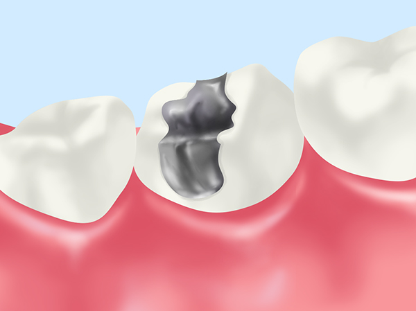メタルインレー（保険）