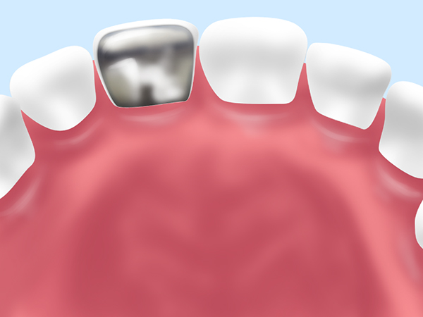 レジン前装冠　（保険）