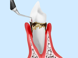 歯周病としっかり向き合うために