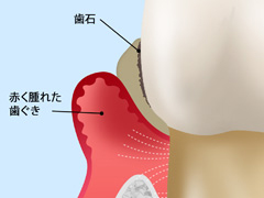 中等度の歯周病