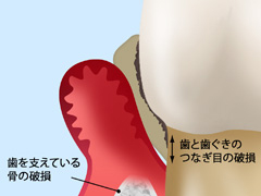 重度の歯周病